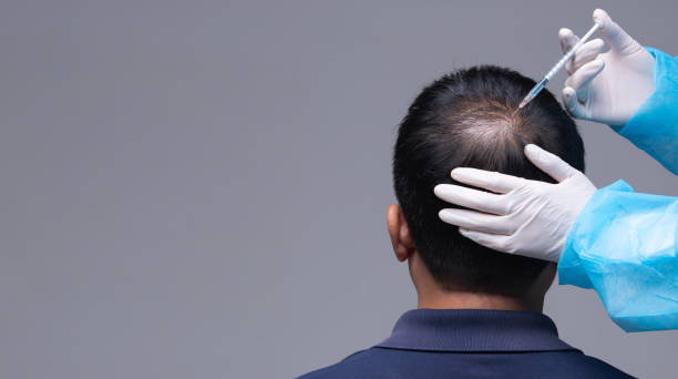 Why TCM is a Popular Hair Loss Solution in Singapore